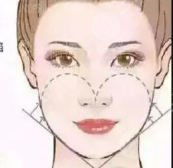 成都天之美整形好吗？自体填充变美日记倾情分享