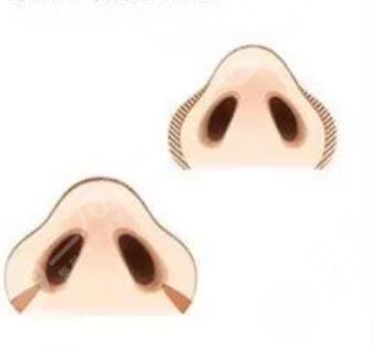 成都美上美整形口碑如何？隆鼻整形术后果倾情分享