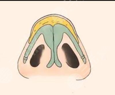 北京壹加壹隆鼻整形案例分享与果对比图