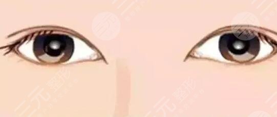 华西医院肖海涛双眼皮手术价格及真实果图