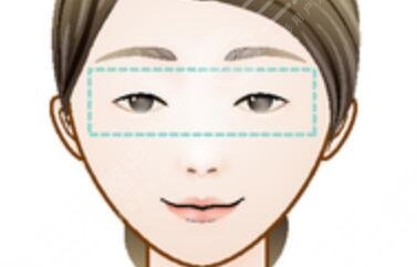 北京协和朱琳和黄久佐技术点评，附双眼皮案例图