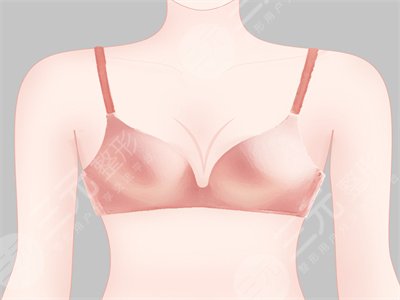 自体脂肪隆胸怎么样  自体脂肪隆胸术后果图