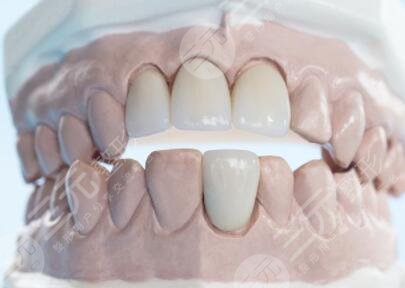 真实牙齿矫正案例  隐性牙齿矫正恢复过程分享