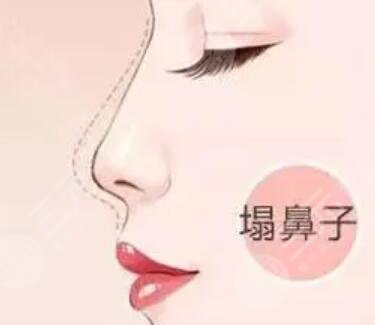 隆鼻整形真人案例 隆鼻整形恢复过程分享