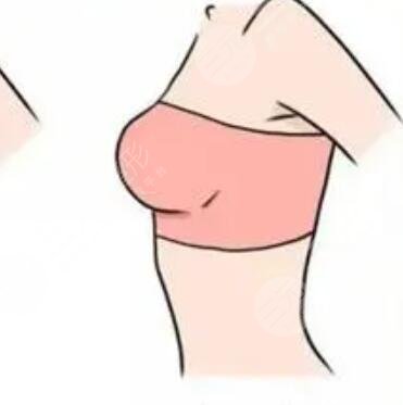 假体隆胸果图 假体隆胸果对比