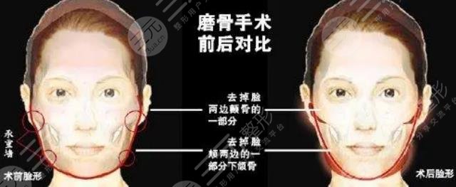 磨骨手术有什么风险和后遗症？看完你还想做吗？