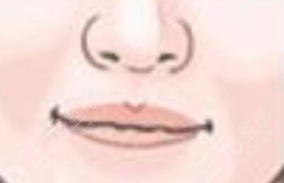 丰唇手术前后对比照片