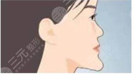侧颜很丑因为嘴巴凸