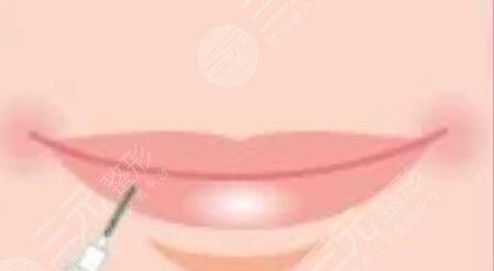 丰唇手术前后对比照片