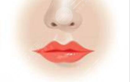 丰唇手术后照片三个月