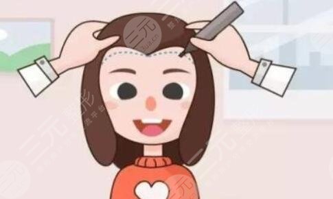 袁瑞红植发案例