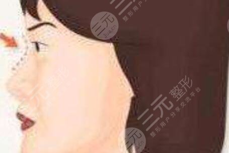 薛克墘做鼻子恢复期