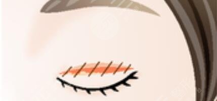 上海华美双眼皮案例