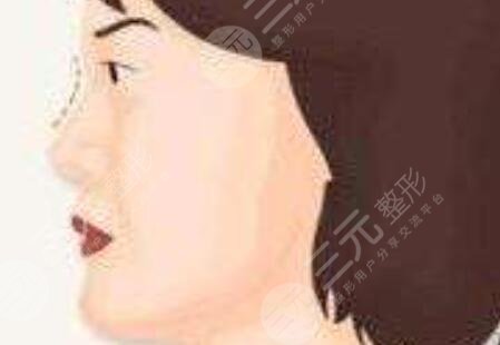 隆鼻第一天到15天过程图片