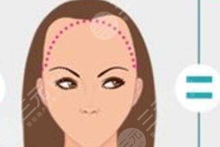 上海华美医院植发怎么样？口碑好吗？附个人植发手术经历分享