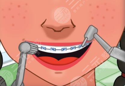 南京博韵口腔医院隐形牙齿矫正经历分享