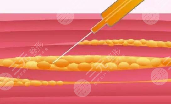 上海洁铭大腿吸脂案例分享