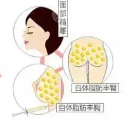 成都玉之光自体脂肪填充面部案例