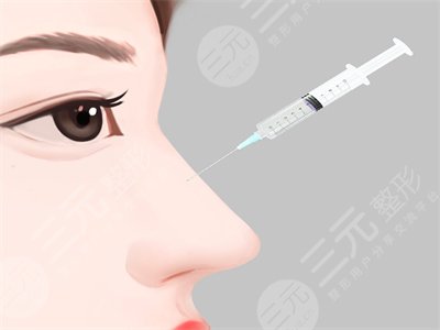 上海第九医院自体软骨隆鼻案例