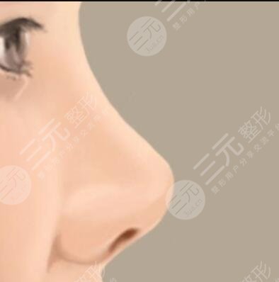 隆鼻术后果图