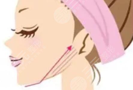 欧洲之星4d提拉双下巴有副作用吗？案例