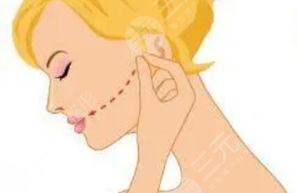 欧洲之星4d提拉双下巴有副作用吗？案例