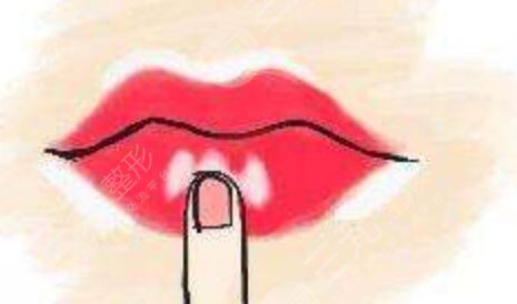 m唇手术真人案例分享