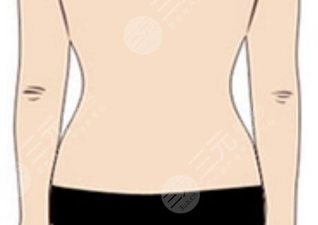 超脂塑溶脂术后会出现凹凸不平的现象吗