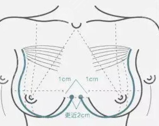乳房下垂矫正术恢复图