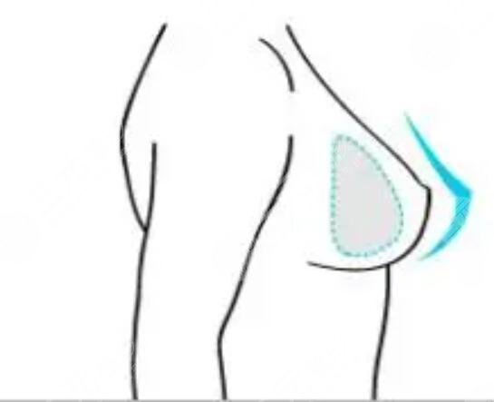 水滴型隆胸躺下后图片