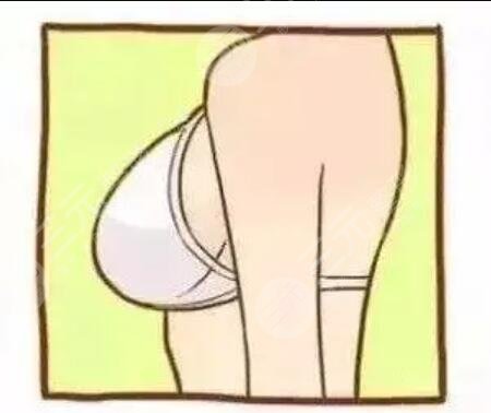 水滴型隆胸躺下后图片