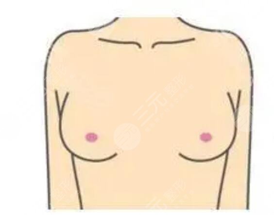 胸下垂矫正后果图