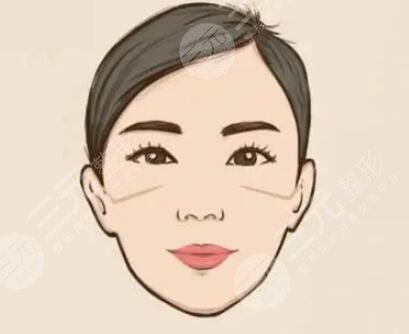 上海九院谢峰脸部脂肪填充术后第22天