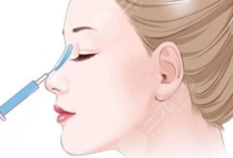 男生整容鼻子术前