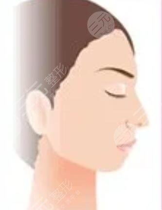 武汉三医院整形美容科垫下巴案例：我也是有下巴的人了~