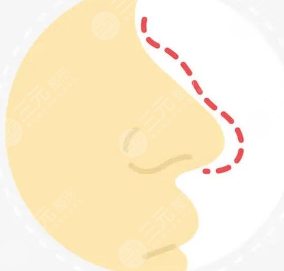 真人案例图来喽，看看隆鼻手术1-7天分别是什么样子？