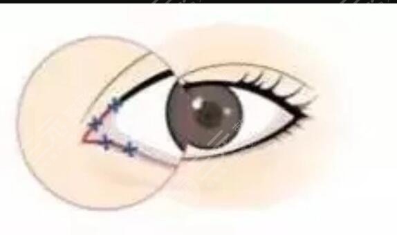 埋线双眼皮七天恢复图