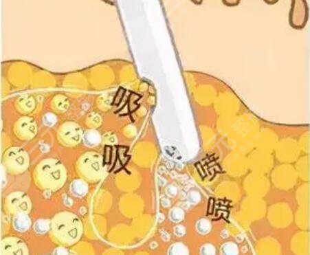 臀部吸脂15天恢复图