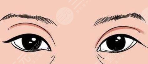 双眼皮术后10天