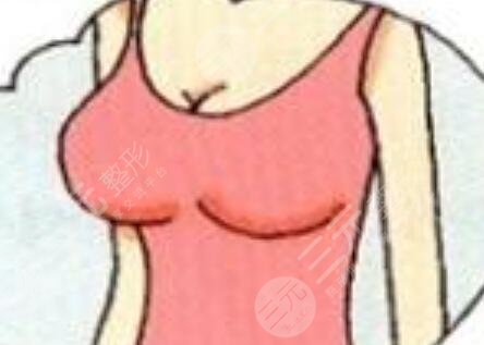 隆胸手术前后照片