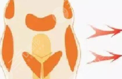 下巴打玻尿酸的后遗症有哪些？真实案例果反馈