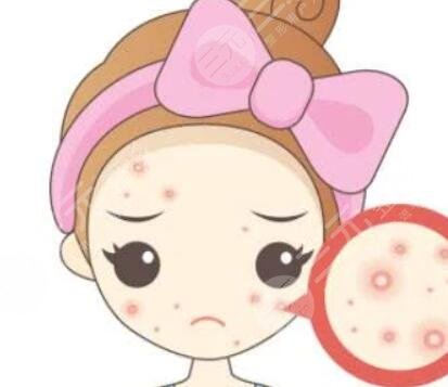 激光去痘痘成好吗？激光去痘痘真人体验！