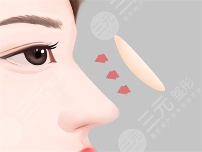 耳软骨垫鼻尖恢复过程图：8个月果参考一下！