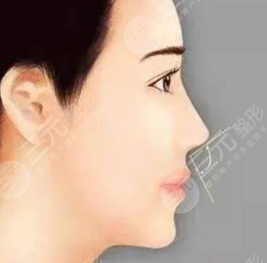 小翘鼻子整形图片:8个月的韩式小翘鼻诞生日记~