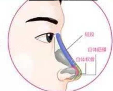 鼻翼过宽整容缩小案例