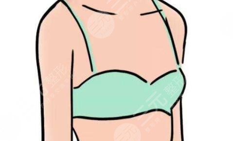 假体隆胸后的图片