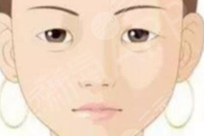 案例：开眼角1个月恢复过程图，真人照片展示~