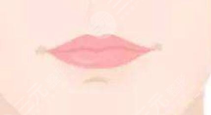 玻尿酸丰唇吸收后能恢复原来的唇型吗?