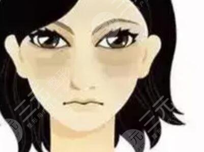 眼部注射玻尿酸去泪沟