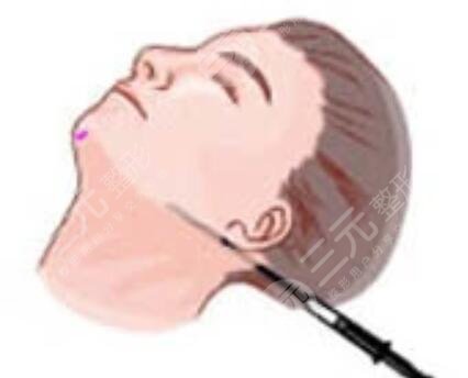 脂肪填充10天恢复